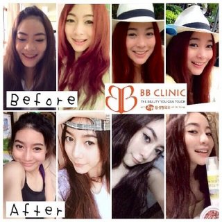 ราคาเสริมจมูก bbclinic