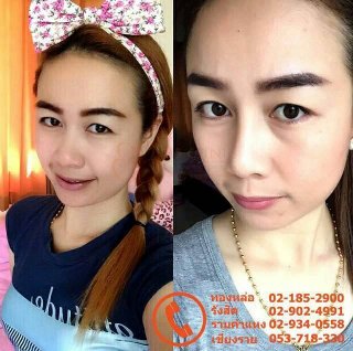 ร้อยไหม ยกกระชับใบหน้า bb clinic 0836482485 คุณแมว