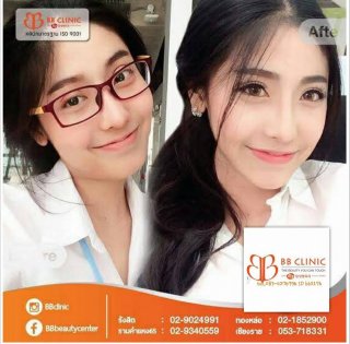 เสริมจมูกหยดน้ำbb clinic ราคาจมูกหยดน้ำ bb เสริมจมูกปลายพุ่งbb 