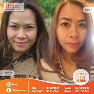 ศัลยกรรมปากกระชับ ปากบาง ปากกระจับ bb clinic 0836482485 คุณแมว(พยาบาล)