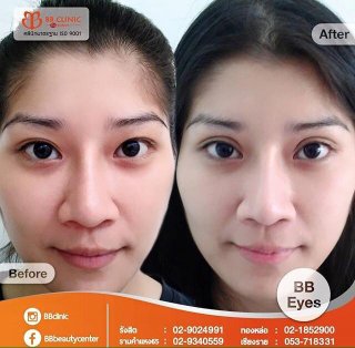 ศัลยกรรมทำตา 2 ชั้น หนังตาตก bb clinic ตาสวย ธรรมชาติ0836482485