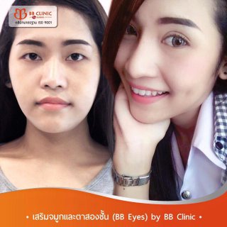 ศัลยกรรมเสริมคาง bb clinic